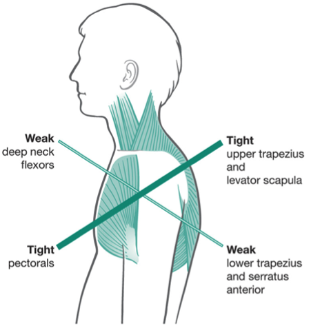SUBACROMIAL SHOULDER IMPINGEMENT SYNDROME